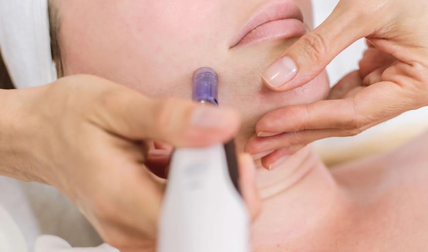 MICRONEEDLING